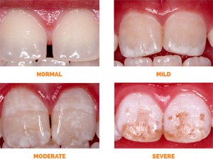 Fluorosis