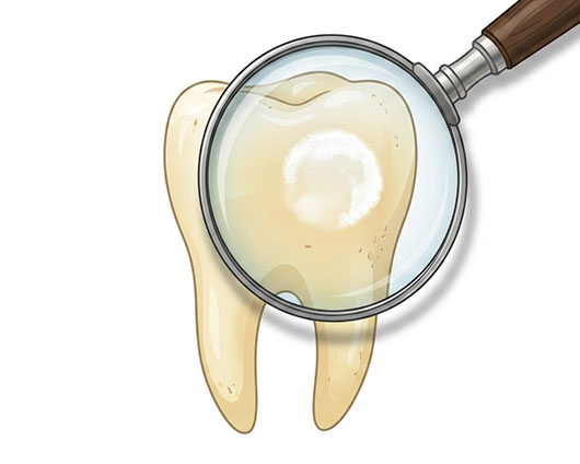 What Is Fluorosis?